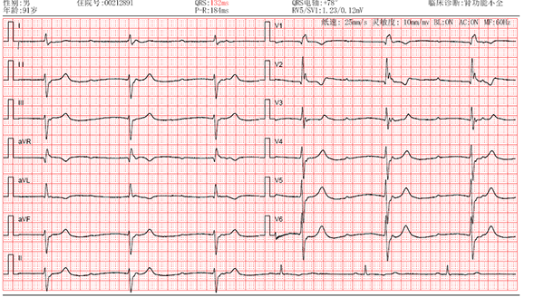 心电图rv5和sv1的范围图片