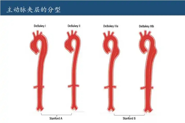 debakey分型图片